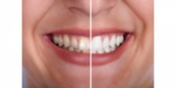 resultados blanqueamiento dental zaragoza